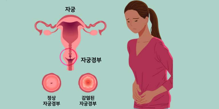 자궁경부암 원인 전조증상 5가지 인유두종바이러스(HPV) 감염 경로는?